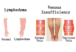 5 Ways to Tell Lymphedema Apart from Venous Insufficiency